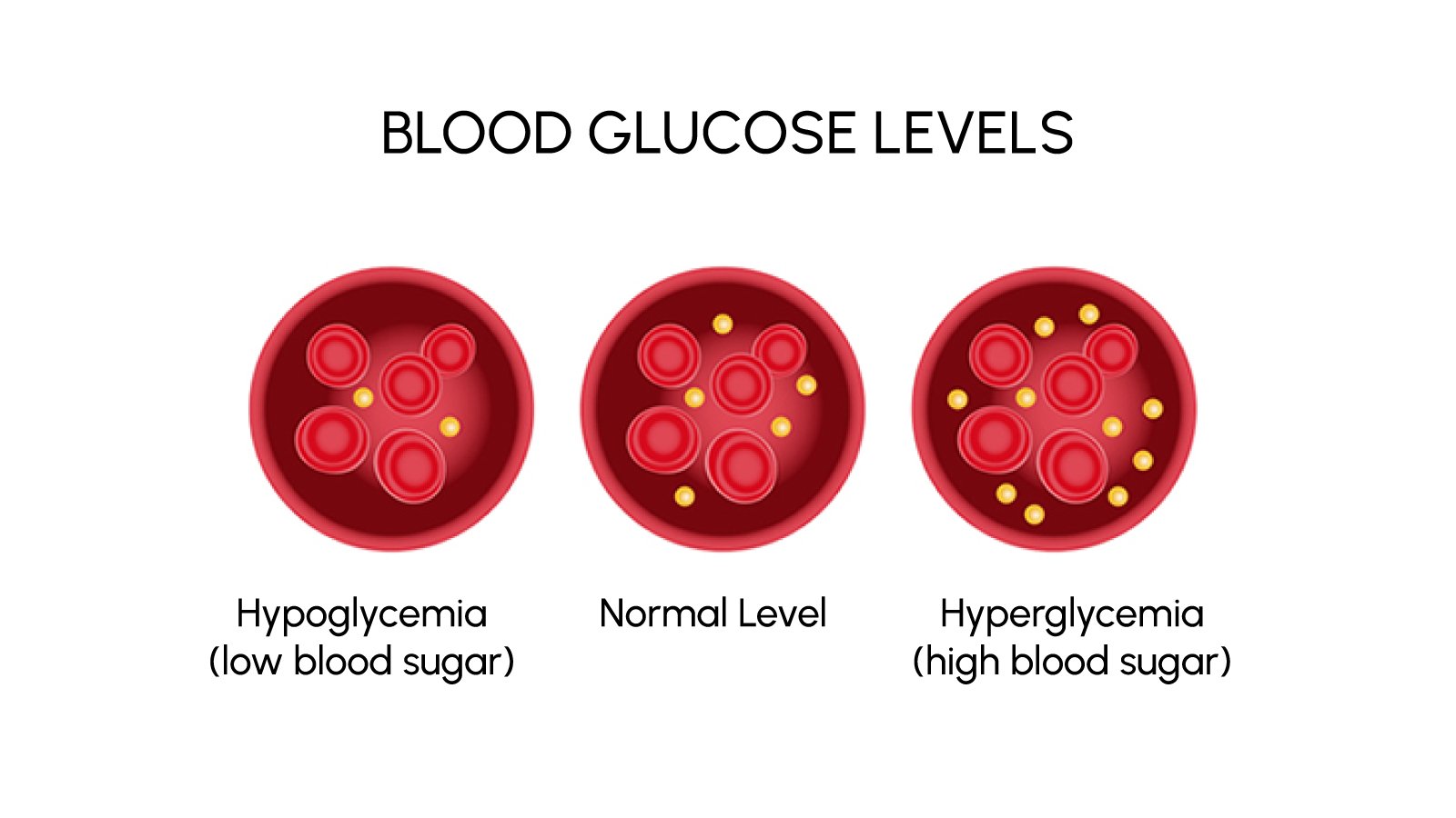 Figure 3. Blood glucose spectrum: hypoglycemia, normal, hyperglycemia.